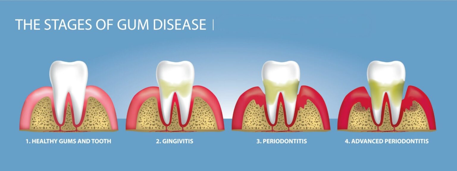 Periodontal Disease Therapy A Northwest Dental 2359